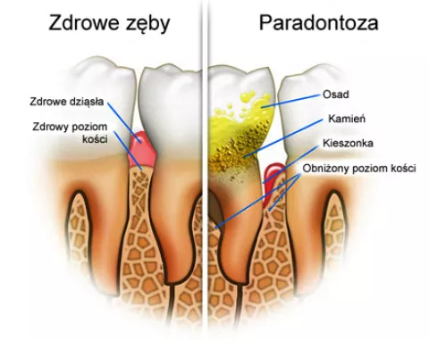 Chirurgiczne leczenie chorób przyzębia: kompleksowe podejście do zdrowia jamy ustnej